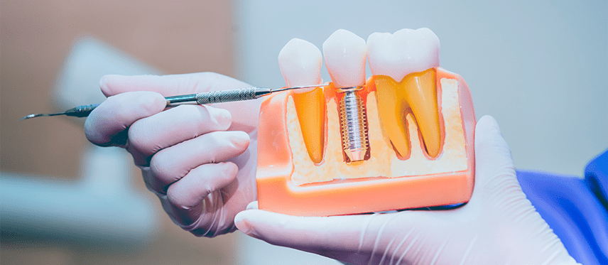 implantes dentários